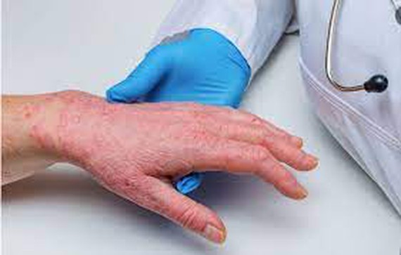 Monkeypox can be cured and prevented with vaccine ảnh 1