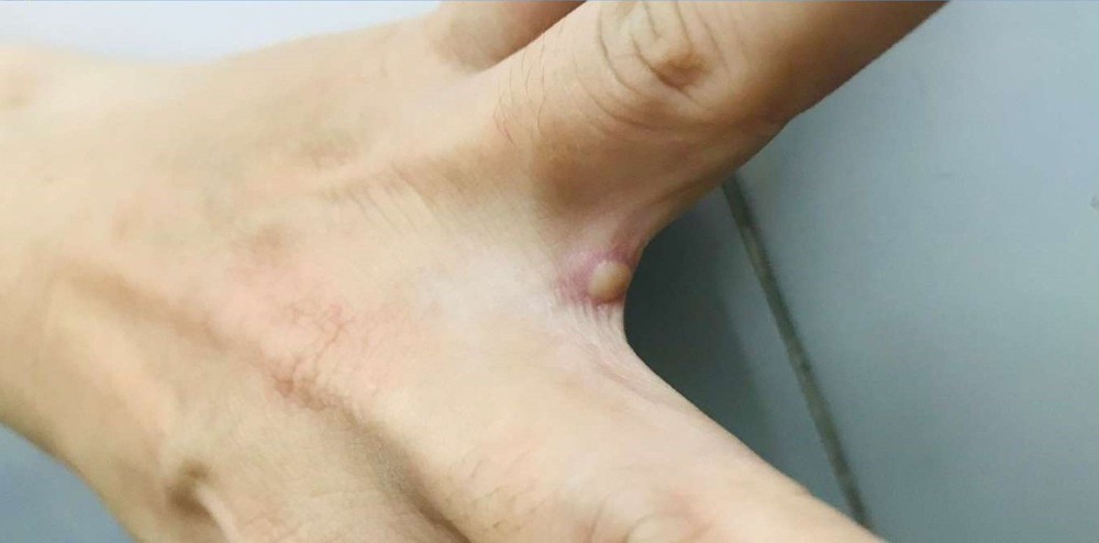 Vietnam’s first monkeypox patient completely cured ảnh 1