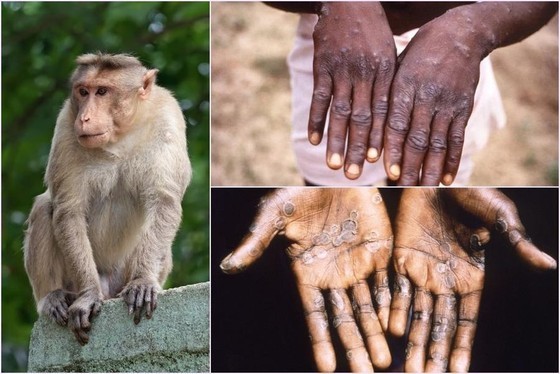 Health watchdog urges to quarantine monkeypox suspected case  in Dak Lak ảnh 1