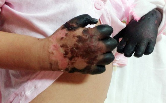 Ministry urges to monitor well cases of skin anthrax