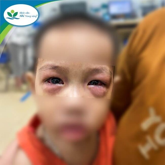 More than 50 children are infected with acute conjunctivitis