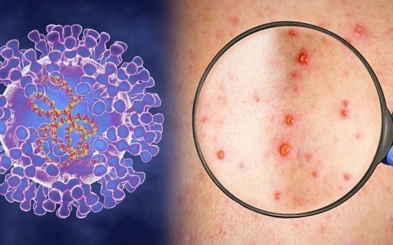 Ben Tre Province records its first monkeypox case Ben Tre Province records its first monkeypox case