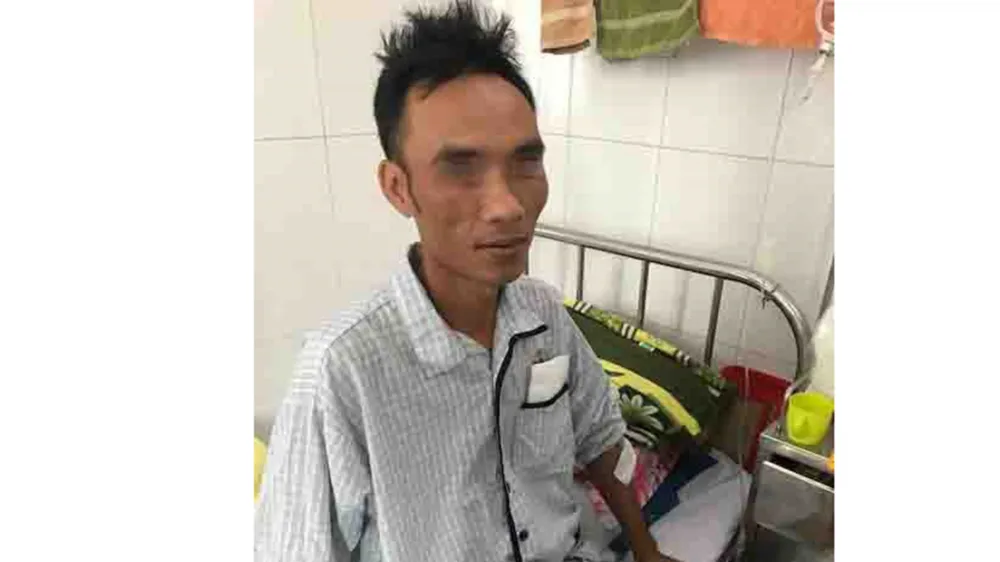 Cứu bệnh nhân bị vỡ tá tràng do cọc bê tông ép vào bụng