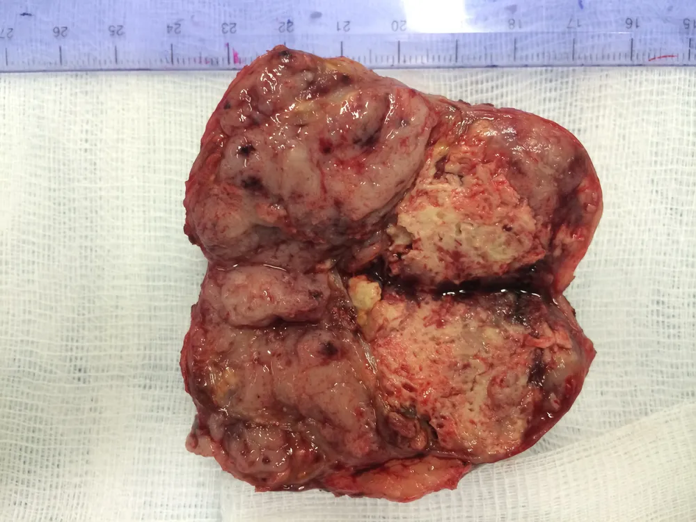 Phẫu thuật thành công bệnh nhân bị ung thư gan tái phát ảnh 1