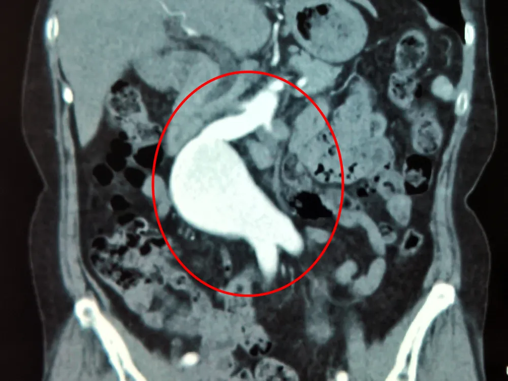 Thay động mạch chủ phình to có nguy cơ vỡ cho bệnh nhân  ảnh 1