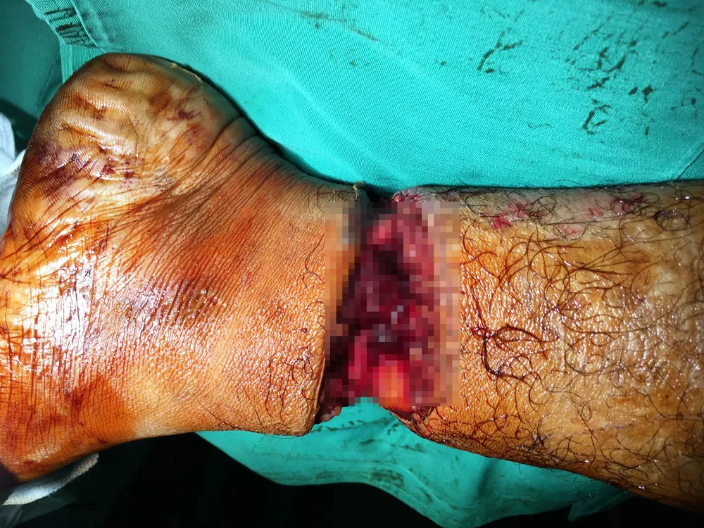 Nối lại cẳng chân gần đứt lìa cho nam thanh niên sau tai nạn lao động ảnh 1