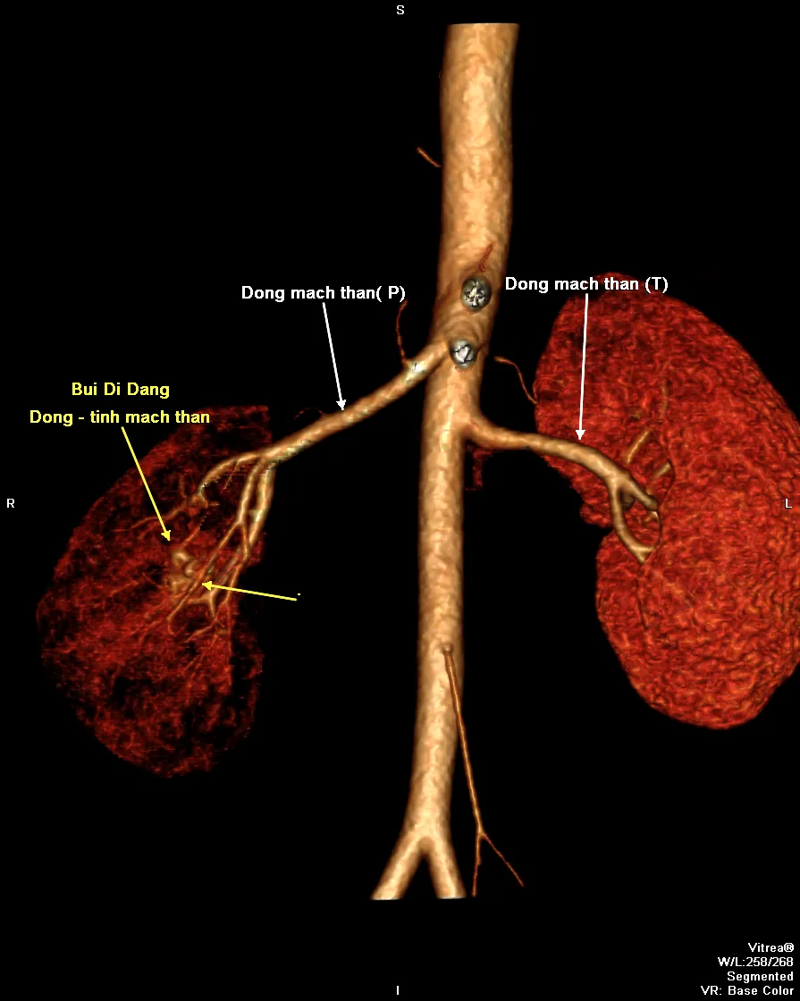 Can thiệp nội mạch thành công chữa dị động tĩnh mạch hiếm gặp ở thận  ảnh 1