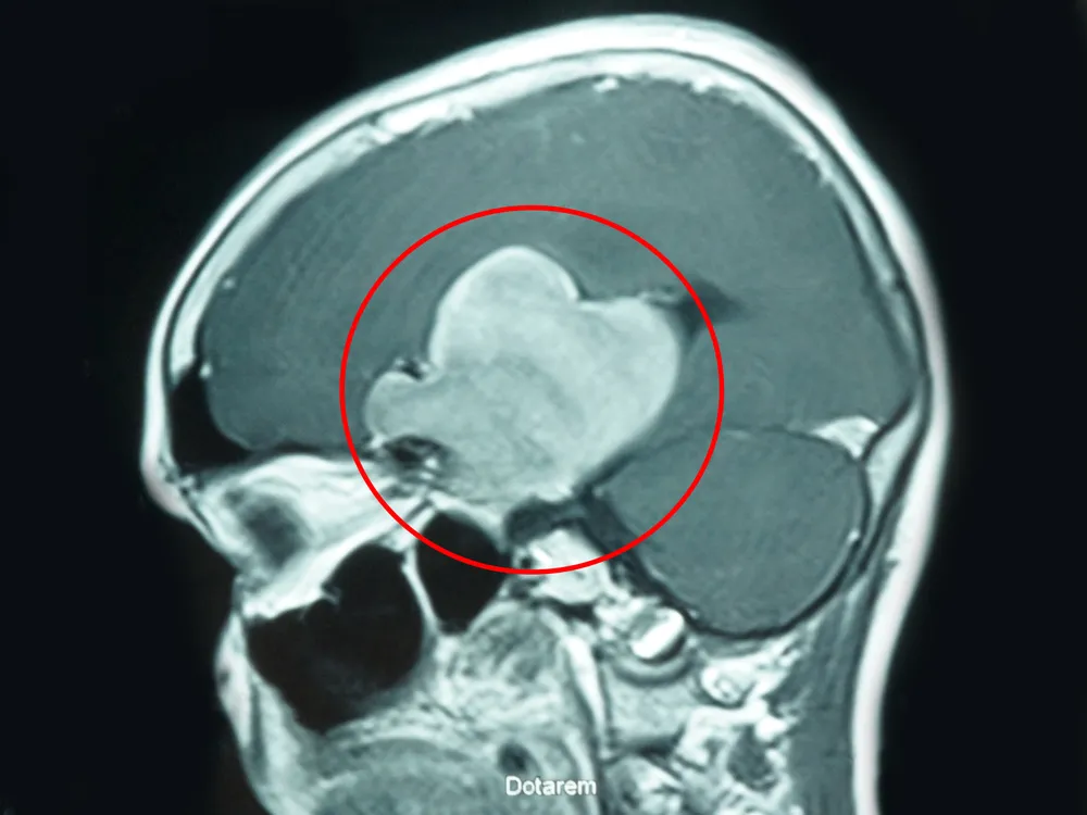 Bóc tách thành công khối u não khổng lồ cứu sống bệnh nhân ảnh 1