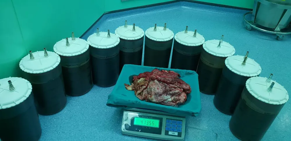 Phẫu thuật thành công u nang buồng trứng nặng 50kg ảnh 1