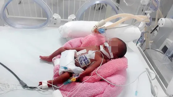 Cứu sống bé gái sinh non nặng 600g mắc bệnh tim bẩm sinh ảnh 1