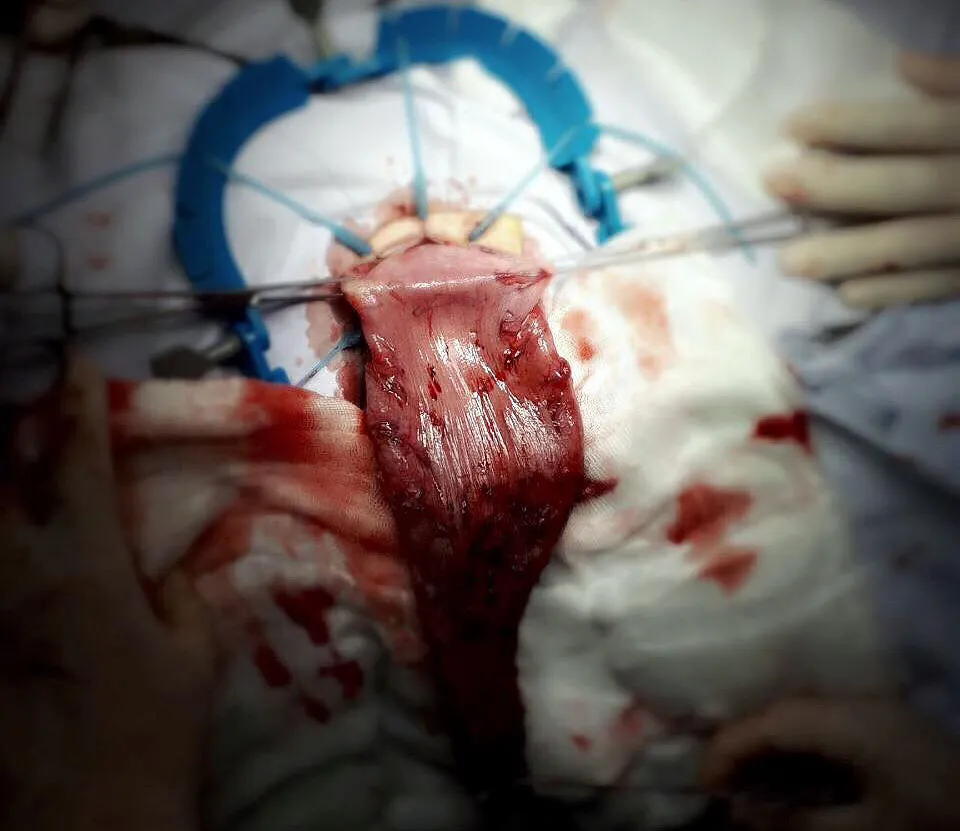 Bé trai táo bón hơn 5 năm, bụng phình to như phụ nữ mang thai ảnh 1