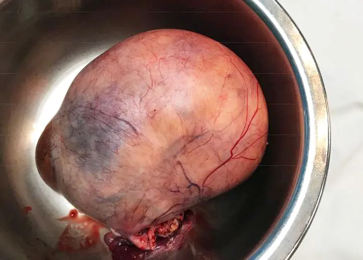 Phẫu thuật thành công cắt khối u nặng hơn 1kg sau 30 năm "chung sống" ảnh 1