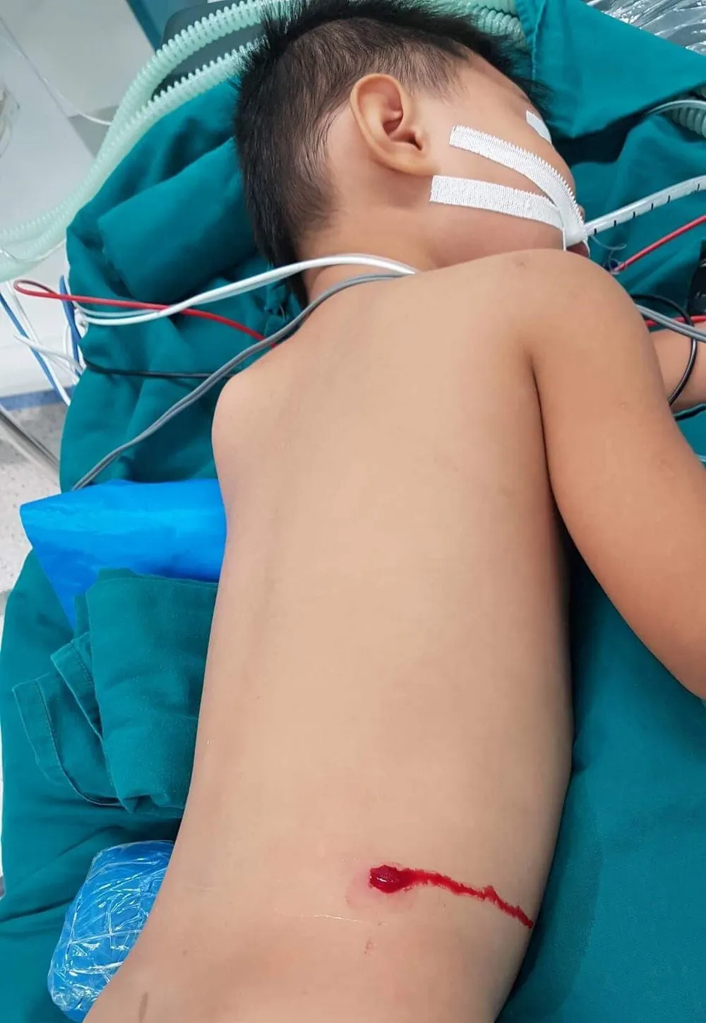 Nghịch súng hơi bắn chim, bé trai 5 tuổi bị súng bắn xuyên thủng hông  ảnh 1