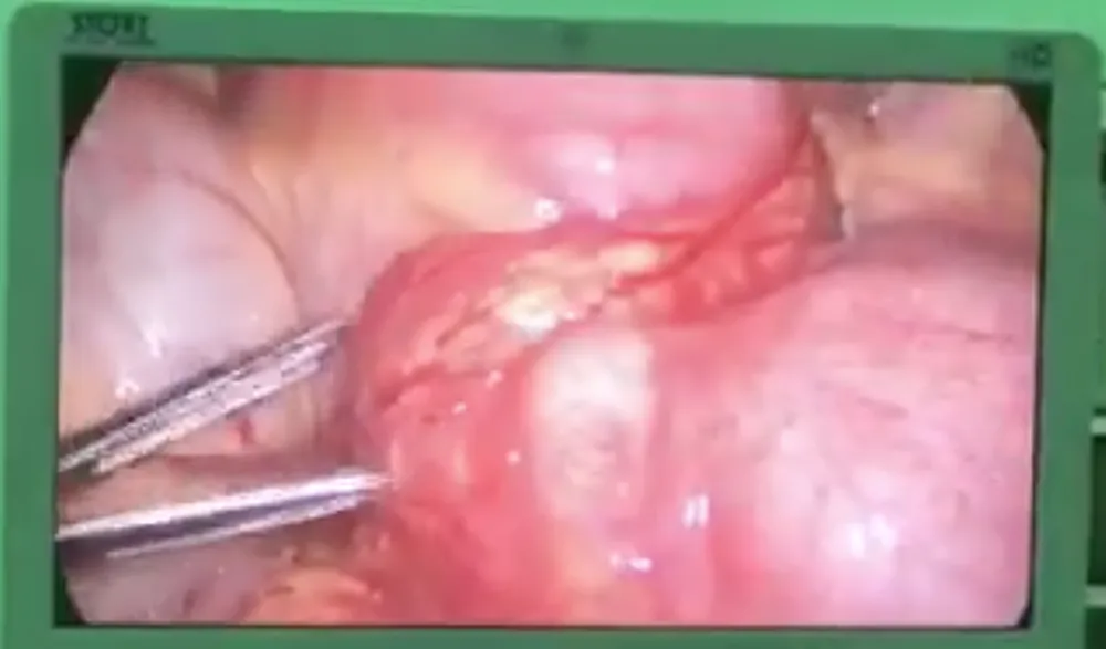 Hình ảnh phẫu thuật nội soi gắp dị vật