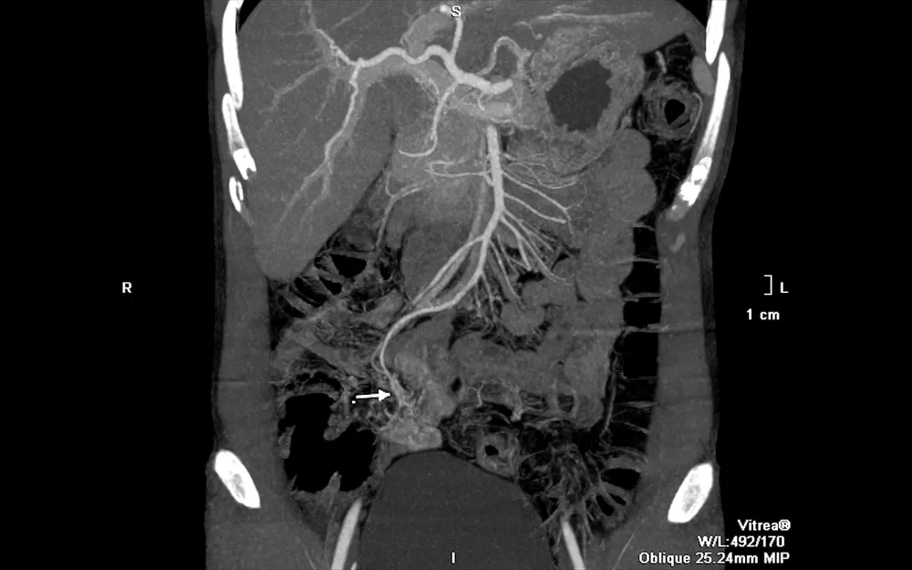 Làm gì khi nôn ói ra máu bầm liên tục? ảnh 1