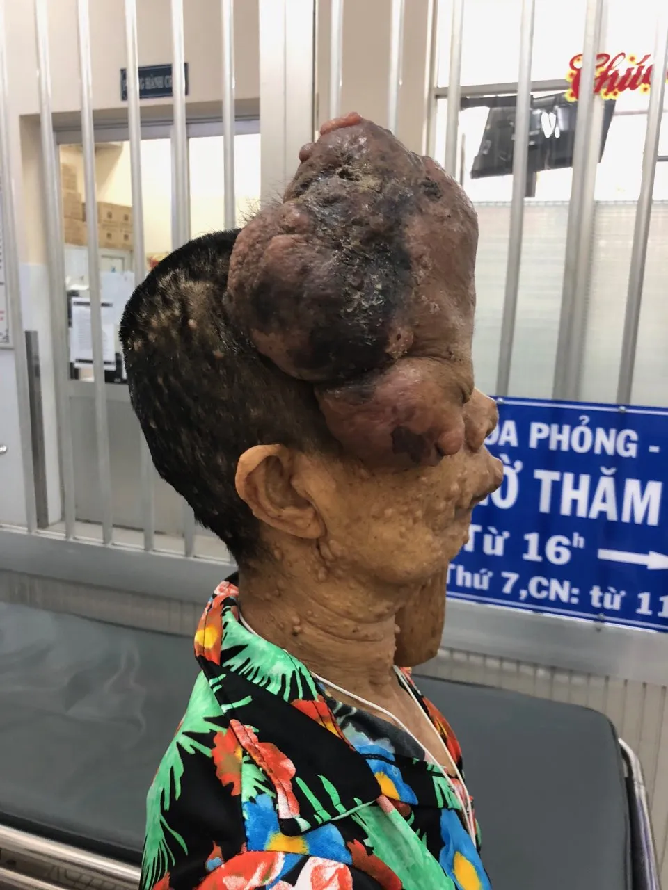 Phẫu thuật thành công khối bướu thần kinh lớn khiến khuôn mặt người phụ nữ biến dạng ảnh 1