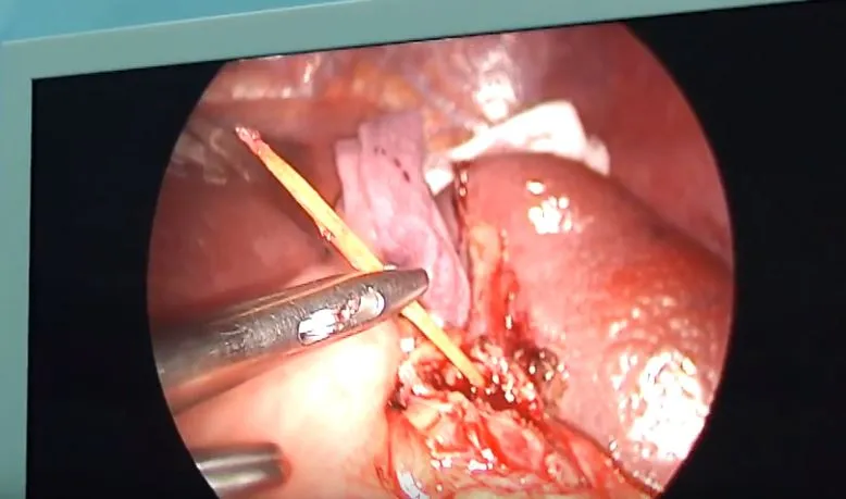 Ngậm tăm đi ngủ, một người đàn ông bị xuyên thủng lá lách ảnh 1