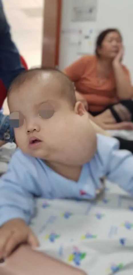 Phẫu thuật tạo hình thành công cho bé trai mang khối bướu khổng lồ ở má ảnh 1