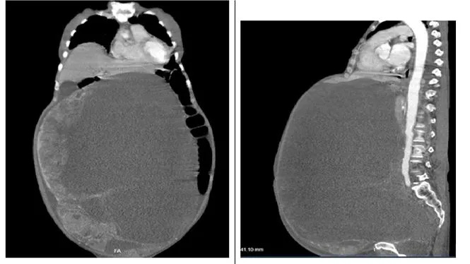 Bóc tách thành công khối u buồng trứng nặng 30kg cho cụ bà 78 tuổi ảnh 1
