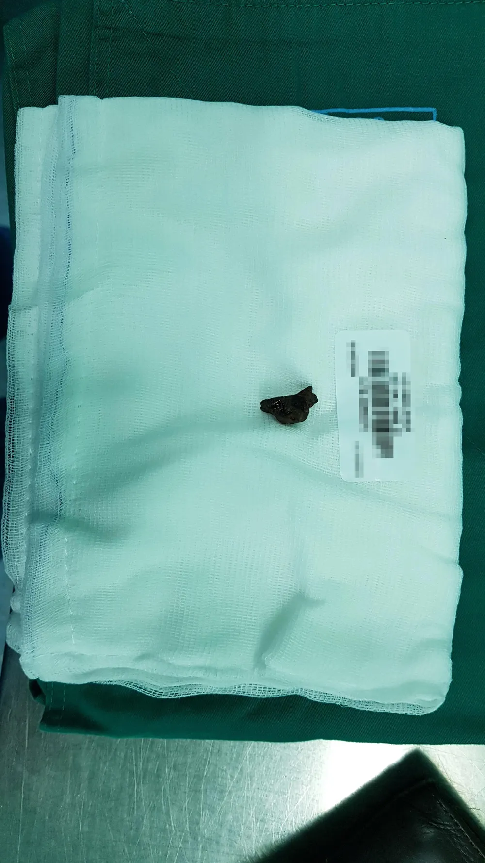 Mảnh đạn nằm trong ổ bụng 40 năm, tạo áp xe “khủng” với 500ml mủ ảnh 1