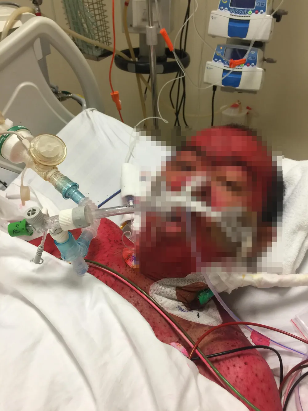 Cứu sống bệnh nhân người Campuchia bị hôn mê sâu vì tự ý dùng thuốc ảnh 1