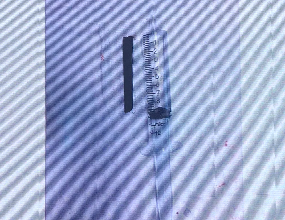 Đoạn đũa dài 7cm được lấy ra thành công