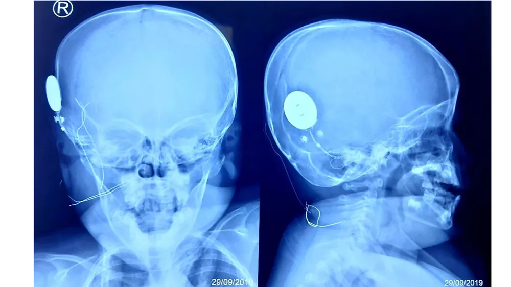 Mang lại âm thanh cho bé gái 40 tháng tuổi bị điếc bẩm sinh ảnh 1