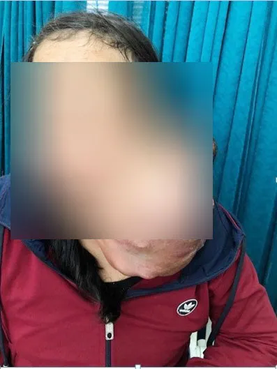 Phẫu thuật thành công khối u vùng cổ nặng 3 kg cho nữ bệnh nhân ảnh 1