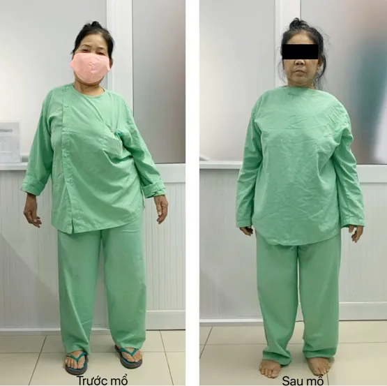 Phẫu thuật thành công một ca cong vẹo cột sống nặng, phức tạp ảnh 1