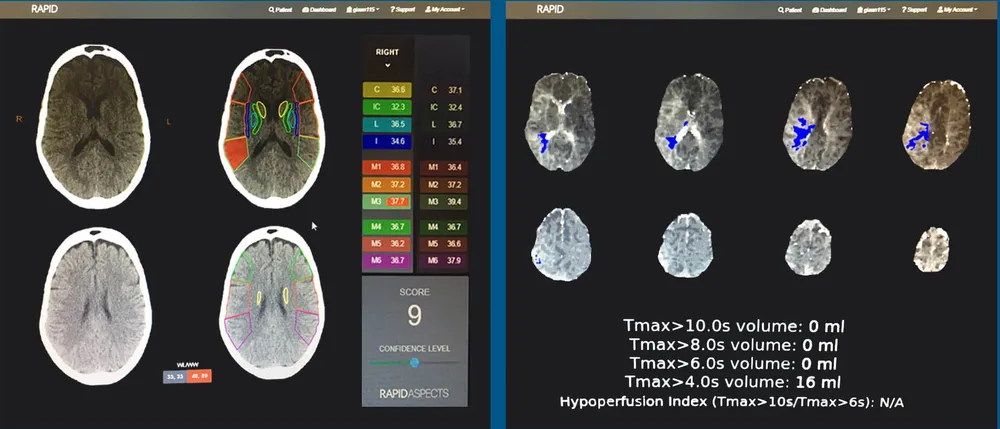 Cứu sống kịp thời một phụ nữ bị đột quỵ não cấp ảnh 1