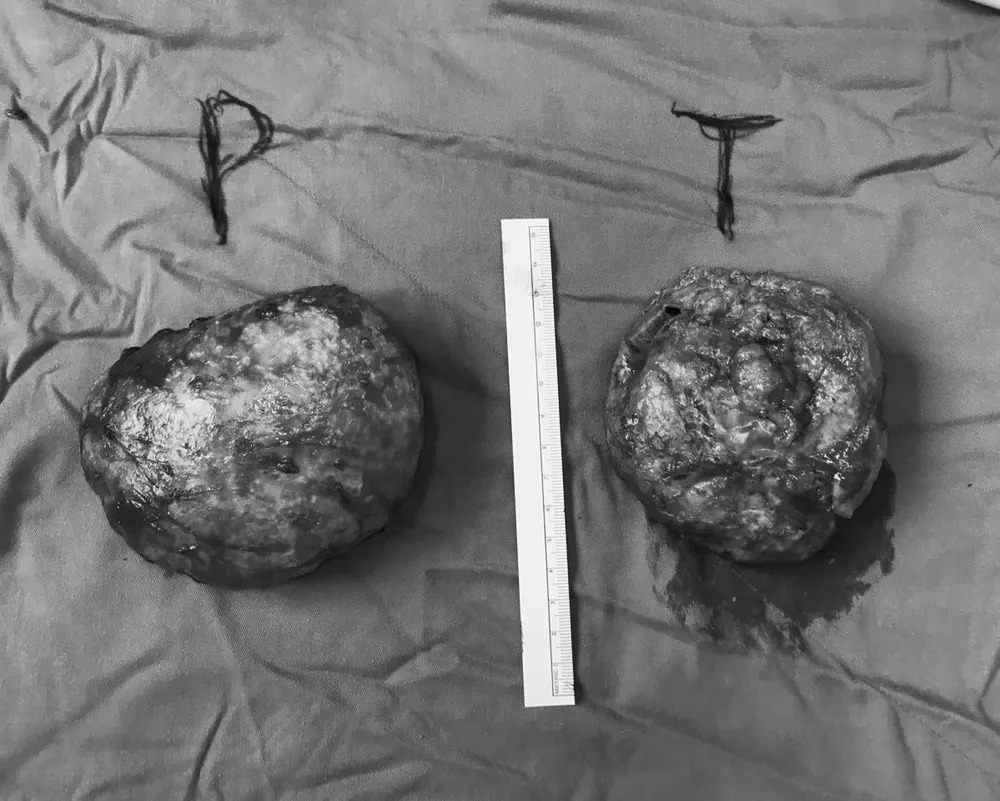 Một phụ nữ nhập viện vì vỡ túi ngực nhân tạo ảnh 1