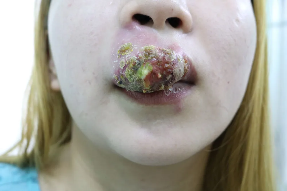 Một phụ nữ bị nhiễm trùng, môi sưng phù nề sau khi xăm ảnh 1