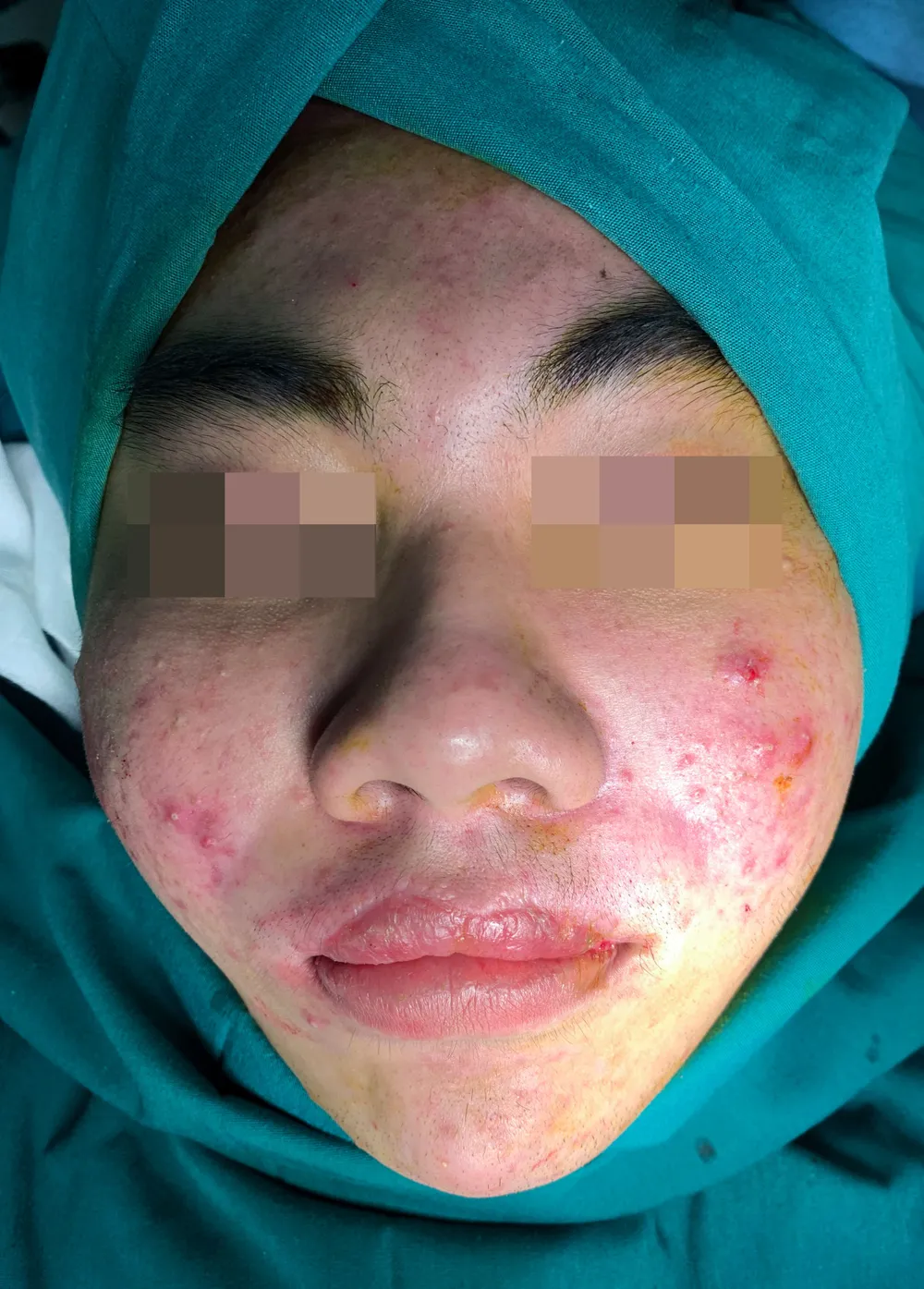 Cả xóm nhập viện vì tiêm ''silicon Thái xách tay'' ảnh 1