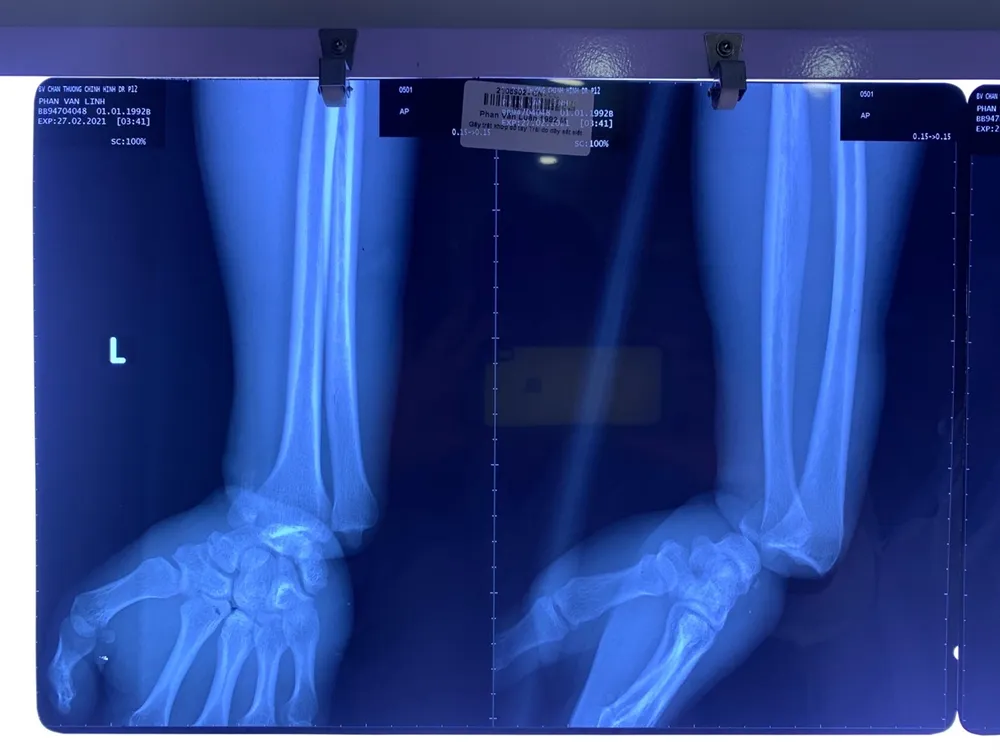 Tai nạn lao động khiến nam thanh niên suýt mất chức nặng vận động tay ảnh 1