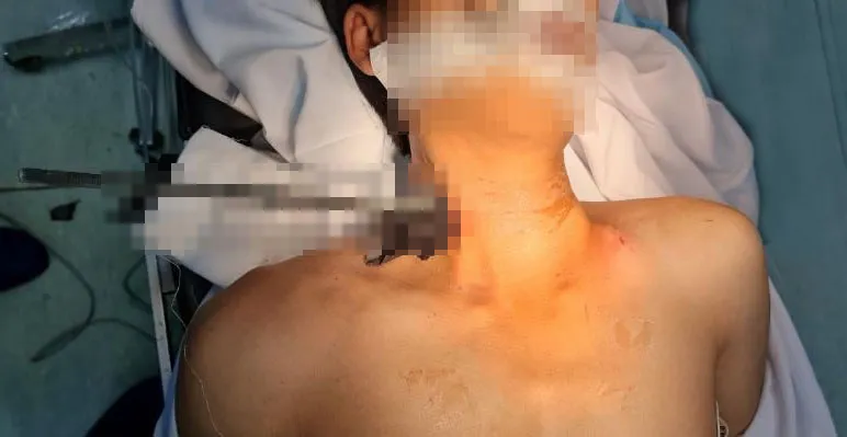 Cứu sống kịp thời công nhân bị thanh sắt đâm xuyên cổ ảnh 1