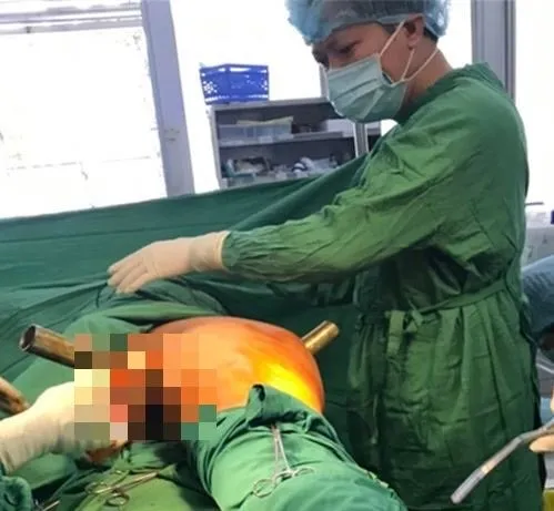 Cấp cứu thành công nam thanh niên bị ống sắt lan can cầu đâm xuyên vùng bẹn ảnh 1