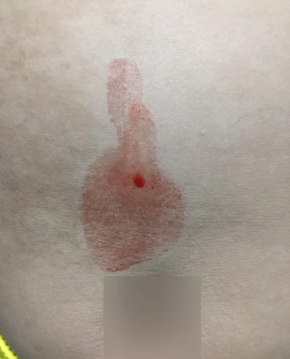 Phát hiện một trường hợp bị “mồ hôi máu” hiếm gặp ảnh 1