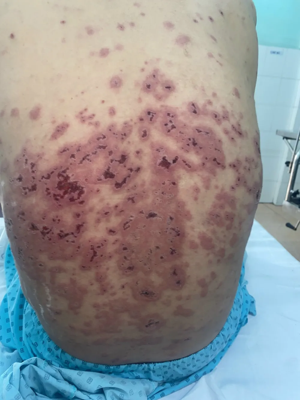 Phát hiện ca bệnh Rowell hiếm gặp trên thế giới ảnh 1