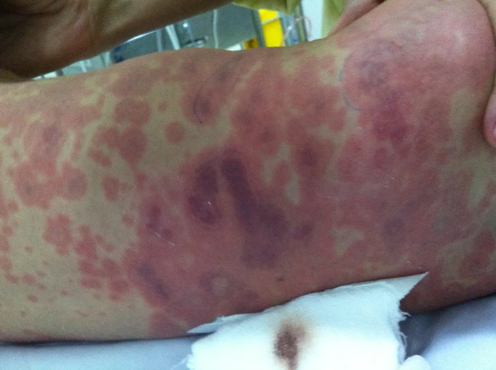 Thanh thiếu niên có nguy cơ cao lây nhiễm viêm não mô cầu và bạch hầu - uốn ván - ho gà ảnh 4