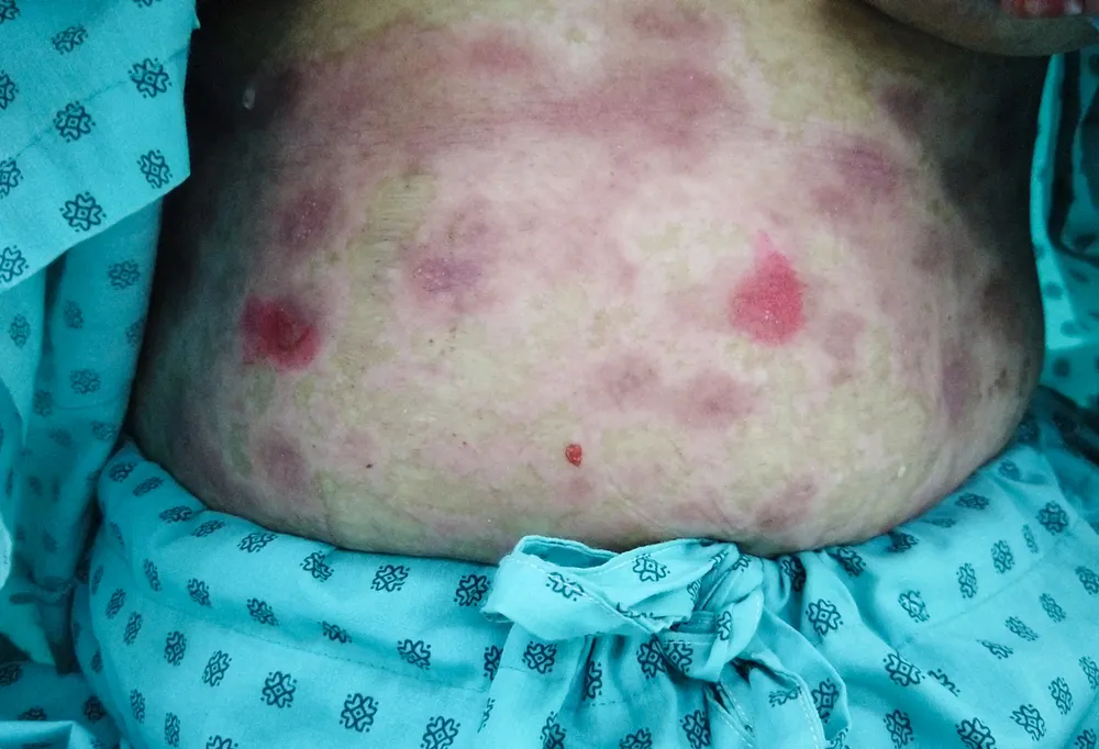 ​Lạm dụng thực phẩm chức năng, bệnh nhân hoại tử thượng bì nhiễm độc nặng ảnh 1