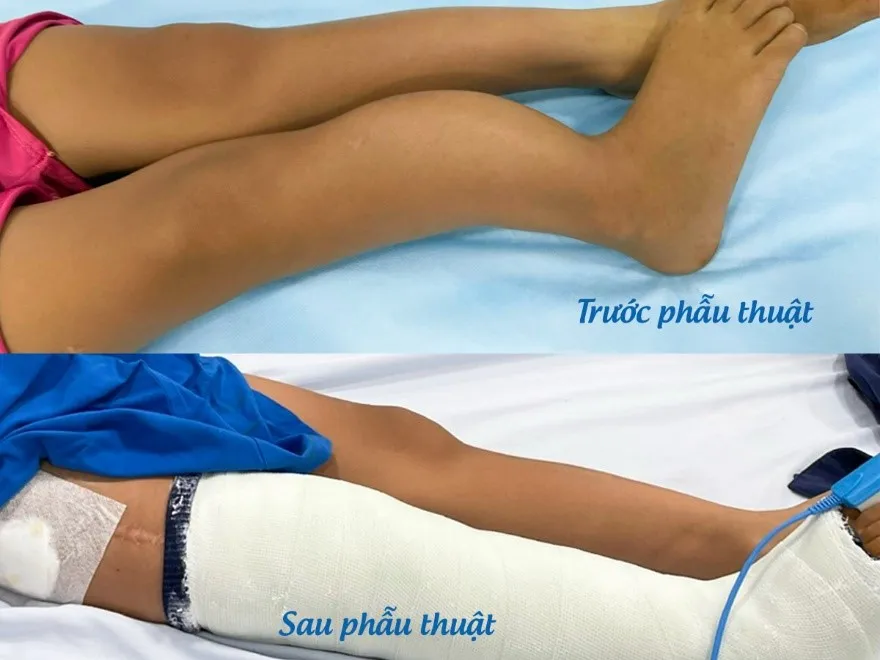 Phẫu thuật thành công cho bệnh nhân bị xương thủy tinh ảnh 1