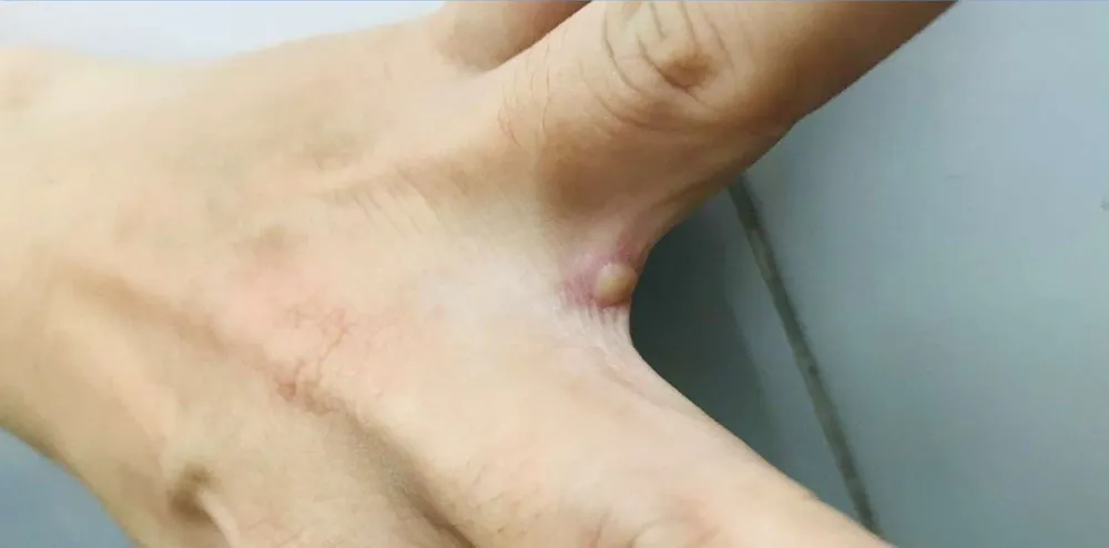 Ca đậu mùa khỉ đầu tiên tại Việt Nam: Sức khỏe đã hồi phục, PCR dịch tiết một số vị trí đã âm tính ảnh 1