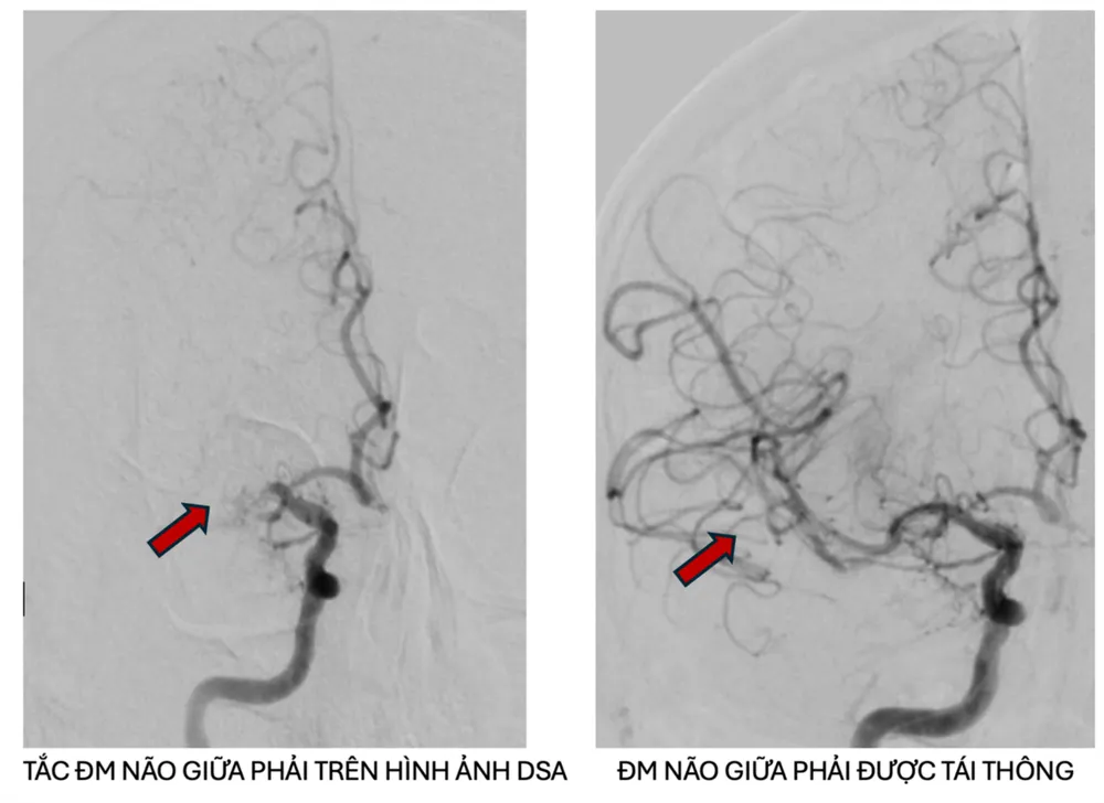 Cứu sống bệnh nhân người Nga bị đột quỵ cấp