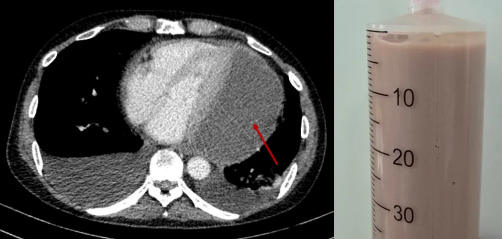 Hình chụp CT lồng ngực xác chẩn với mũi tên đỏ thể hiện lớp dịch mủ chèn ép tim và dịch mủ đặc rút ra được qua chọc dịch màng ngoài tim