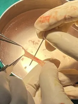 Tạo hình niệu đạo bằng mảnh niêm mạc miệng