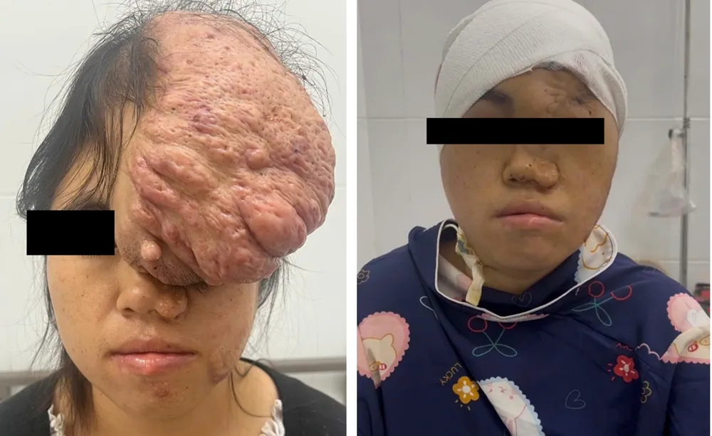 Người bệnh trước và sau phẫu thuật