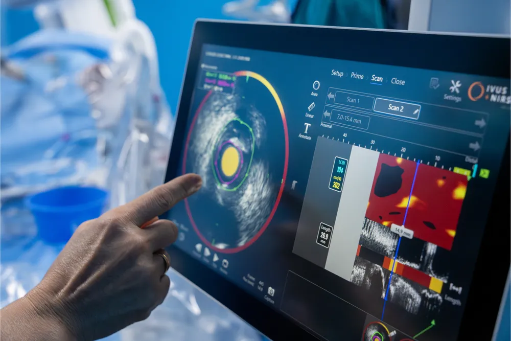 “Mắt thần” giúp phát hiện sớm mảng xơ vữa nguy hiểm