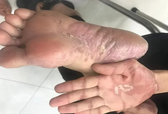 Một ca mắc bệnh giang mai điều trị tại Bệnh viện Da liễu TPHCM