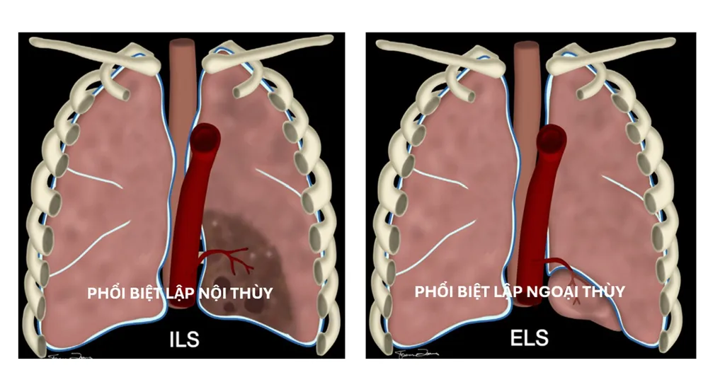 Minh hoạ phổi biệt lập nội thùy và ngoại thùy
