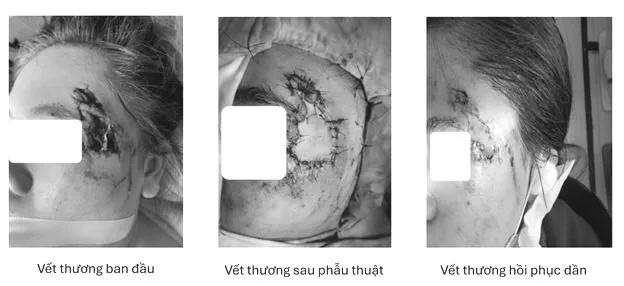 Vùng mặt của người bệnh trước và sau ghép da